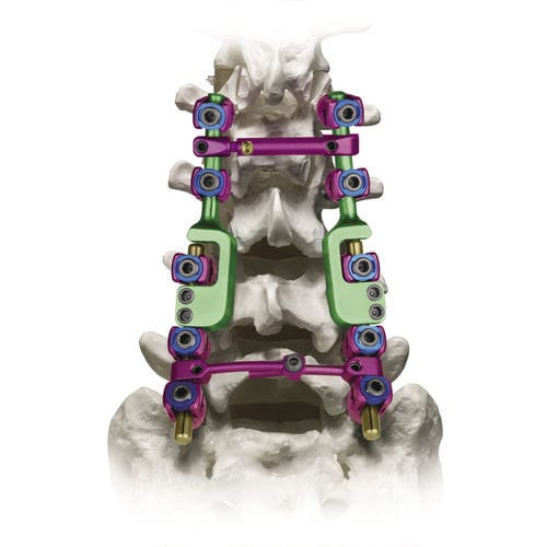 Sistema de osteosíntesis lumbosacro - REVERE® ADDITION® - Globus Medical - vía posterior / para adulto