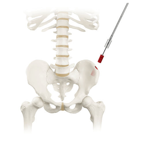 Aguja de biopsia de médula ósea - RETRIEVE® - Globus Medical