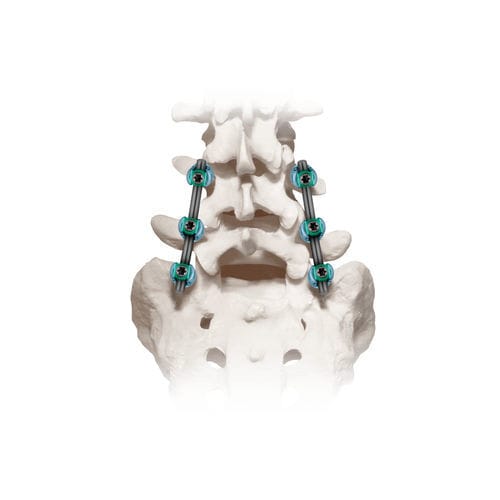 Sistema de osteosíntesis lumbosacro - CREO® 5.5  - Globus Medical - vía posterior / para adulto