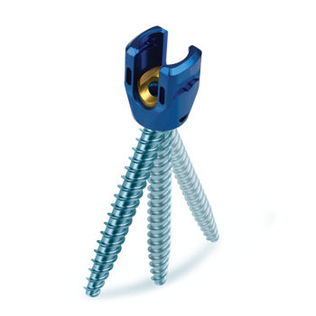 Tornillo pedicular para vértebra lumbar, sacra - REVERE® Uniplanar - Globus Medical - poliaxial / metálico