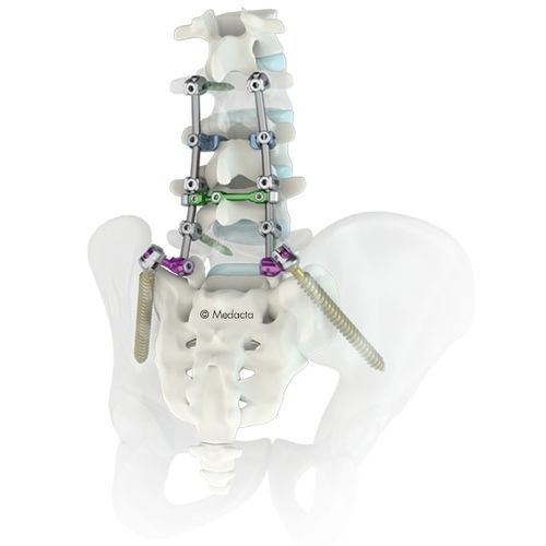 Sistema de osteosíntesis lumbosacro - M.U.S.T.® - Medacta - vía posterior / para adulto