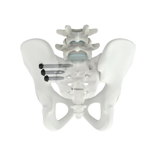 Sistema de osteosíntesis sacroilíaco - M.U.S.T.® SI - Medacta - vía posterior / para adulto