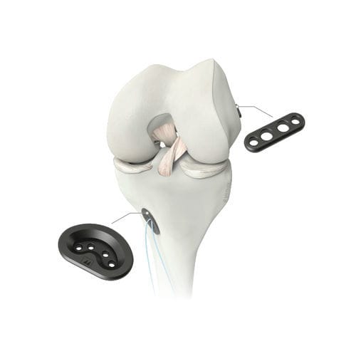 Prótesis de ligamento ligamento cruzado anterior - M-ARS - Medacta - sintética