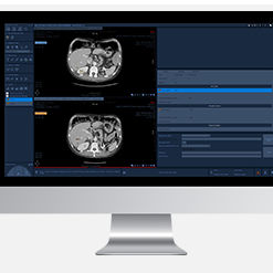 Módulo de software de oncología - Myrian® XL-Onco - Intrasense - médico / TDM / de análisis