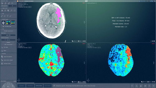Módulo de software TDM - MYRIAN® XP-BRAIN - Intrasense - neurológico / de análisis / de gestión
