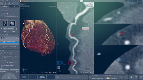 Módulo de software de cardiología - Myrian® XP-Cardiac - Intrasense - médico / de análisis / de visualización