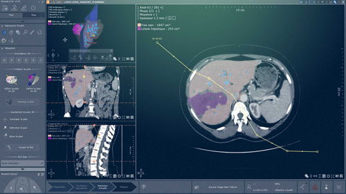 Módulo de software de análisis - Myrian® XP-Liver - Intrasense - de planificación / de simulación en 3D / de radiografía