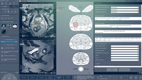 Módulo de software para IRM - Myrian® XP-Prostate - Intrasense - para ecografía / de análisis / de visualización