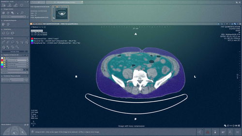 Módulo de software para cuantificación - MYRIAN®XP-ABDOFAT - Intrasense - médico