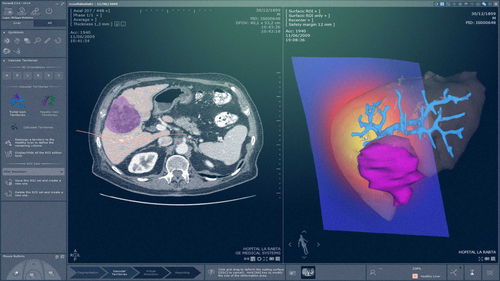 Módulo de software de análisis - MYRIAN®XP-LIVER MRI - Intrasense - de diagnóstico / de evaluación / médico