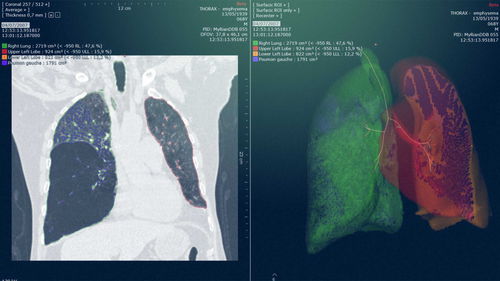 Módulo de software de radiología - Myrian® XP-Lung - Intrasense - para cirugía / de análisis / de planificación