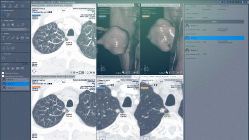 Módulo de software para cirugía - MYRIAN®XP-LUNG NODULE - Intrasense - de análisis / de visualización / de evaluación