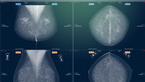 Módulo de software médico - Myrian® XP-Mammo - Intrasense - para mamografía / de análisis / de visualización