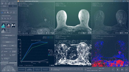 Módulo de software médico - Myrian® XP-Breast - Intrasense - para mamografía / de análisis / de visualización