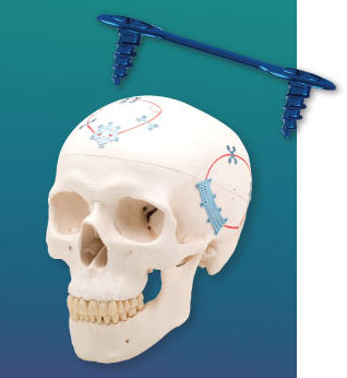 Sistema de fijación craneal no reabsorbible - NeuroPro® Low  - Kinamed