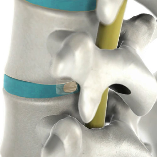 Prótesis de disco lumbar - DISC care™  - NEOS Surgery
