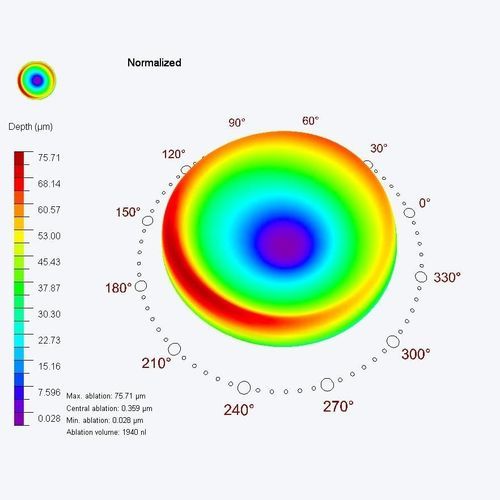 Módulo de software médico - PresbyMAX® - SCHWIND eye-tech-solutions - para oftalmología / de planificación de tratamiento / de ojo