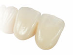 pr&oacute;tesis dental de circona