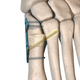 placa de osteotomía para hallux valgus