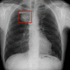 software médico / de visualización / de detección de fracturas / para detección del cáncer de pulmón