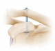 botón de sutura para la reconstrucción del ligamento acromioclavicular