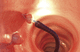cesta endoscopica para la extracción de pólipos intestinales / recta