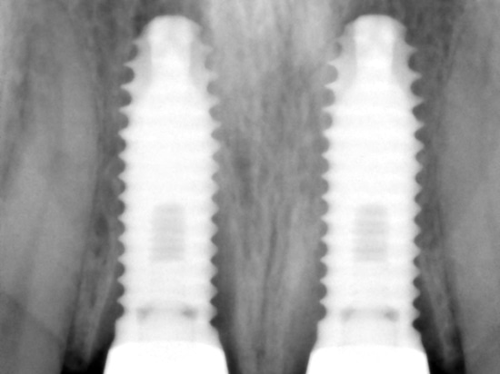 Z1 in situ con el tornillo de la cubierta