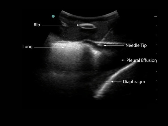 Toracentesis