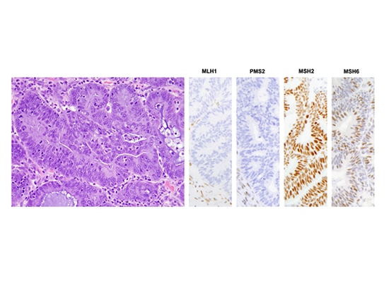 Investigación de genotipado de SpaceGen en carcinoma endometrioide de ovario