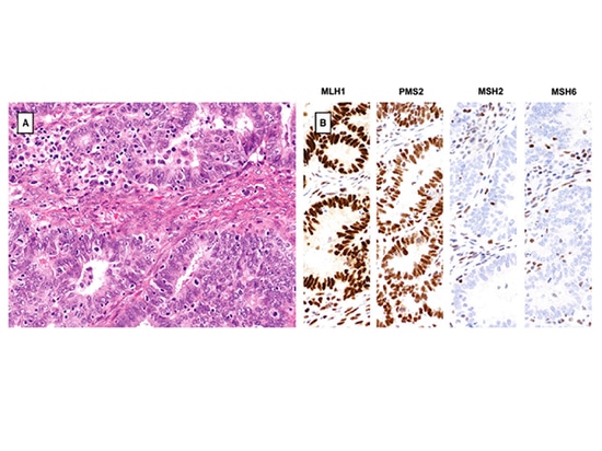 Investigación de genotipado de SpaceGen en carcinoma endometrioide de ovario