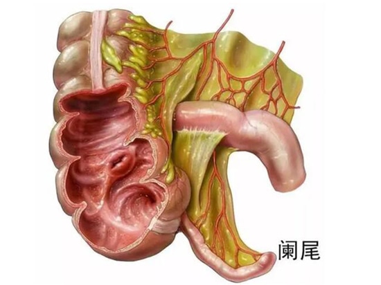 El apéndice no sólo puede inflamarse, sino que también puede sufrir cambios cancerosos Puede suponer un riesgo mortal similar al del cáncer colorrectal.