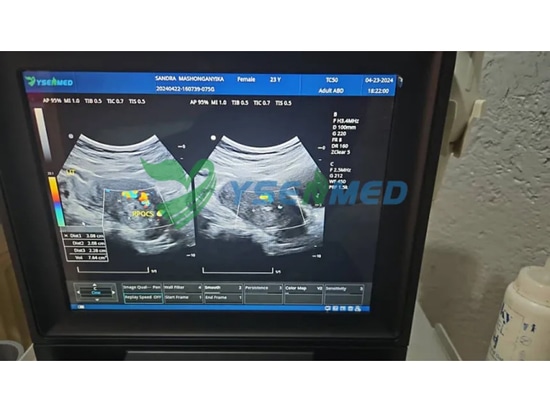 El ultrasonido Doppler color portátil YSENMED YSB-M5 funciona bien en un hospital de Zimbabwe.