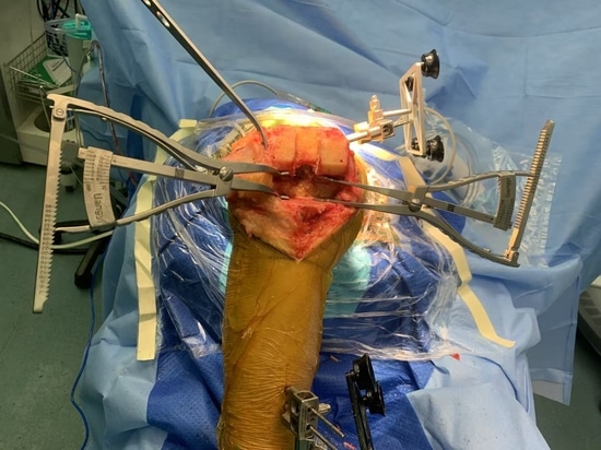 Shandong LiangMed Medical Gap Balancing Spreader con almohadilla circular o almohadilla cuadrada
