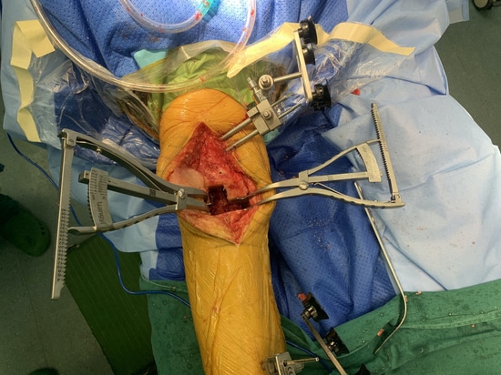 Shandong LiangMed Medical Gap Balancing Spreader con almohadilla circular o almohadilla cuadrada