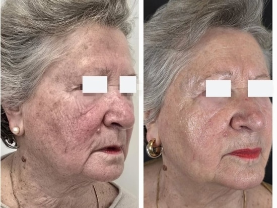 REVYPEEL®: La nueva generación de bio-revitalización sin agujas