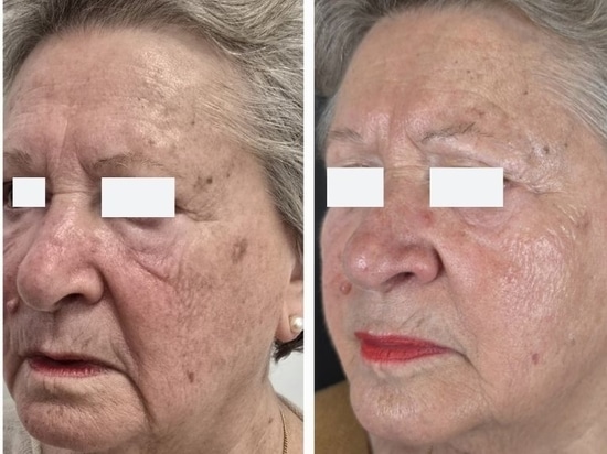 REVYPEEL®: La nueva generación de bio-revitalización sin agujas