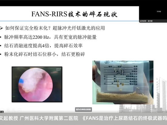Wenqi Wu: ¿Es el FANS el arma definitiva para tratar los cálculos del tracto urinario superior?