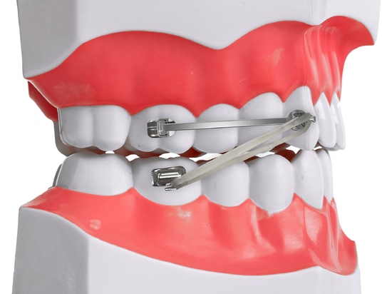 D-BAR - Solución rápida y eficaz para las maloclusiones de clase II