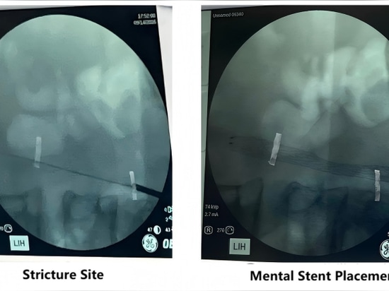 El Primer Hospital Afiliado de la Universidad Médica de Guangzhou ha llevado a cabo con éxito la primera aplicación clínica de un sistema nacional de stent ureteral recubierto para el tratamiento d...