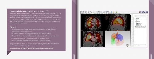 Pulmonary Lobe segmentation prior to surgery