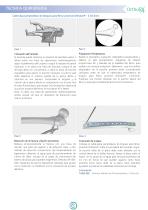 Placa De Bloqueo Para Fémur Proximal Ortholox-5