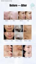 Hydrafacial-8