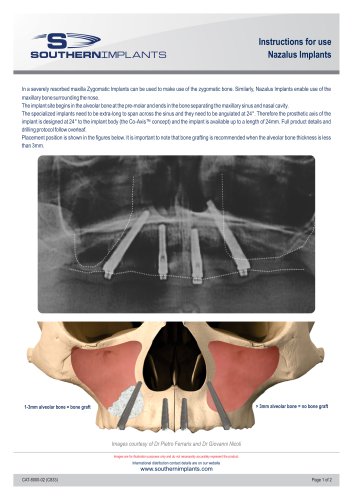 Instructions for use Nazalus Implants