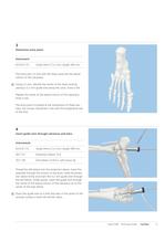 Expert Hindfoot Arthrodesis Nail - 11