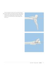 Expert Hindfoot Arthrodesis Nail - 13