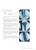 Expert Tibia Nail - 13