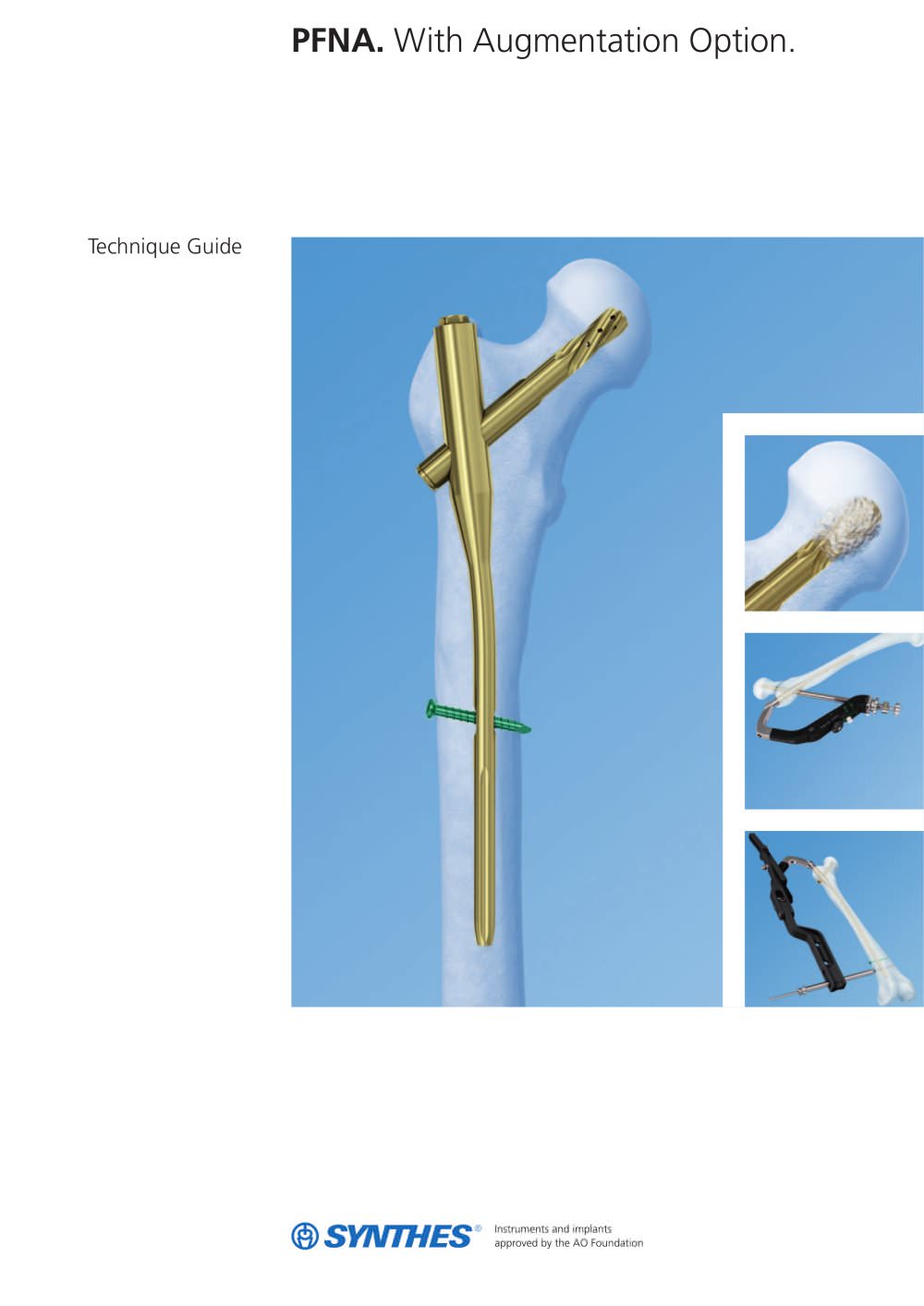 PFNA - Depuy Synthes