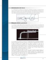 Técnica quirúrgica de Clavo para femur - 11